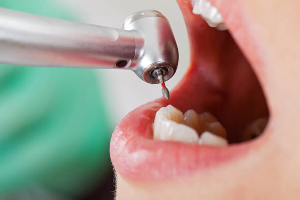 Best Chipped Tooth Repair Near Me  in Fairbury, NE